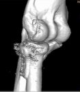 CT Scan repaired arm 1